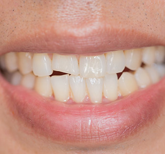 Damaged Teeth?  Fractured Tooth Repair in Fairfield, CT