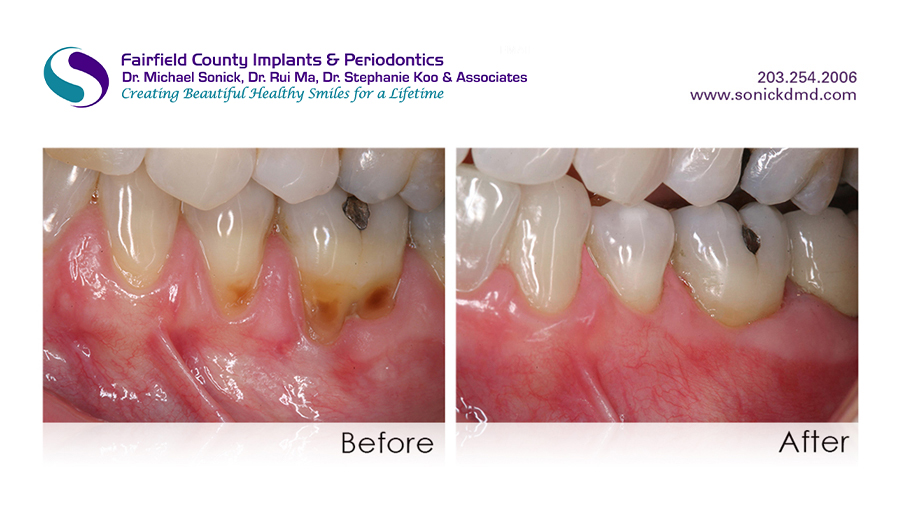 Gum Graphting Before and After