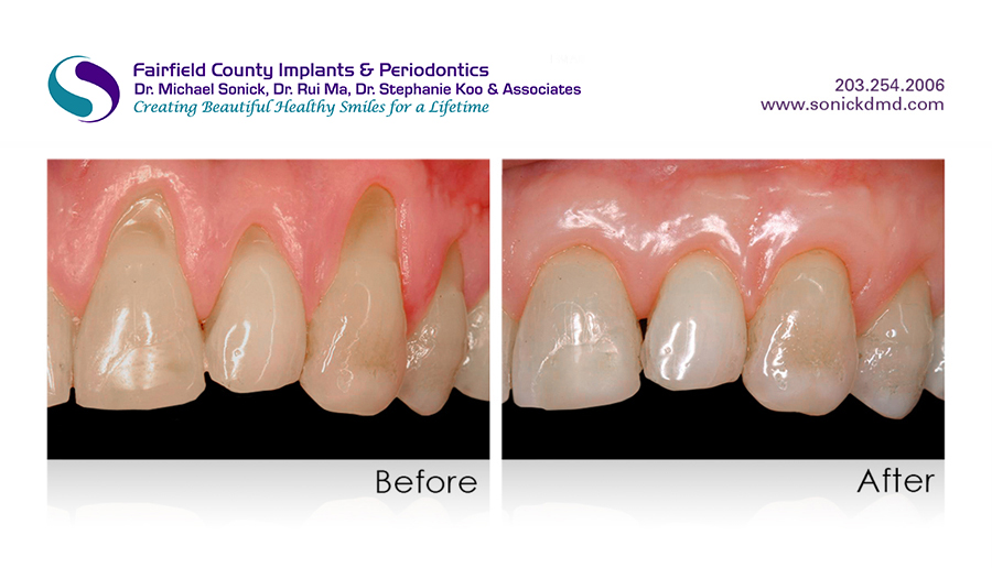 Gum Graphting Before and After