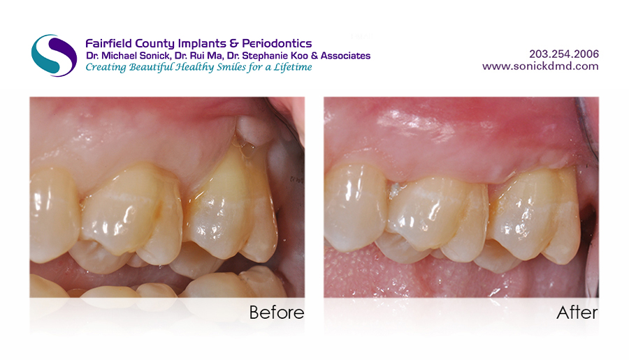 Gum Graphting Before and After